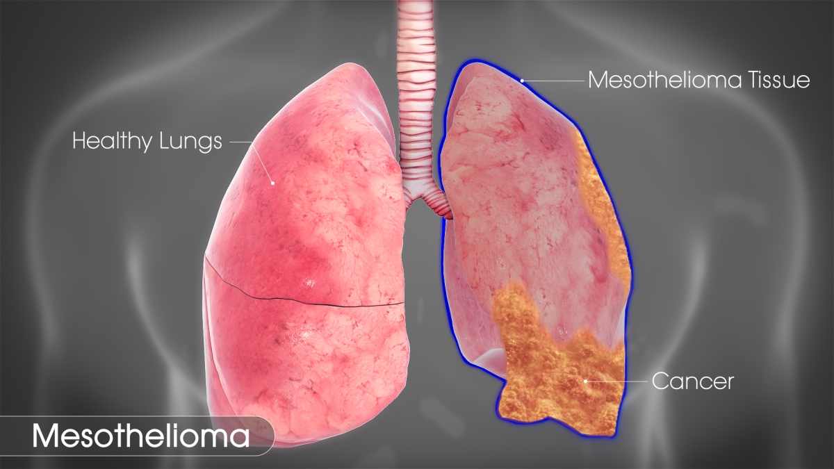 how to stage adenocarcinoma of the lung